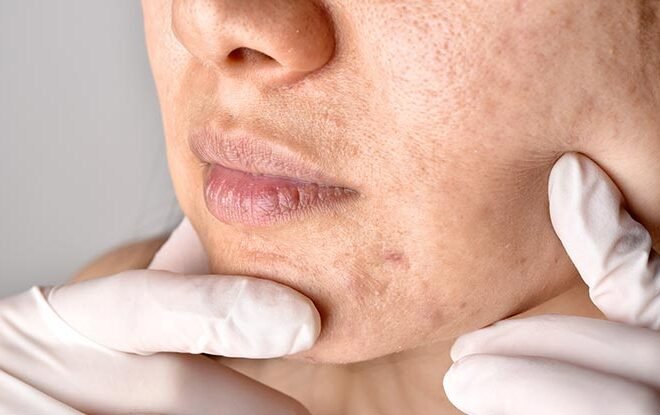 Why Clogged Pores Cause Breakouts and How Facial Steamers Help?