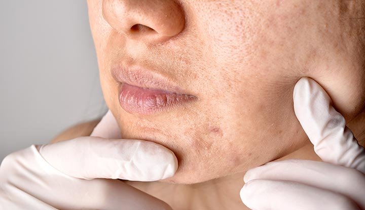 Why Clogged Pores Cause Breakouts and How Facial Steamers Help?
