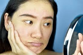 How Can You Improve a Dull-Looking Complexion?